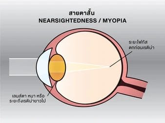 สายตาสั้น